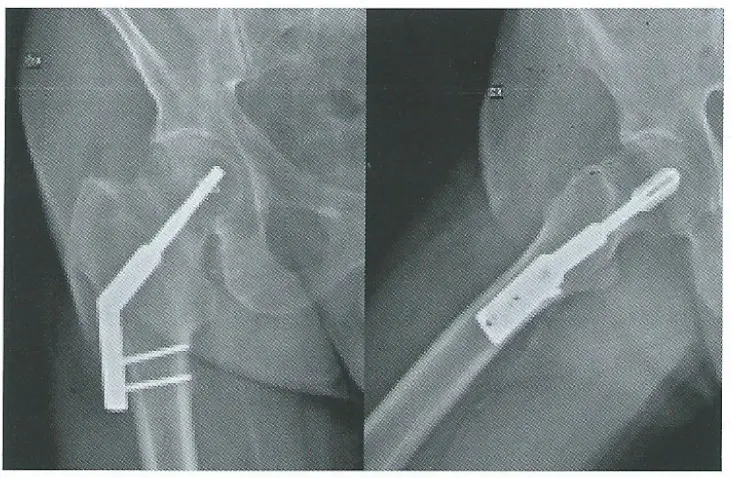 Hip Fracture Implant | Baat Medical Engineering and innovative medical products