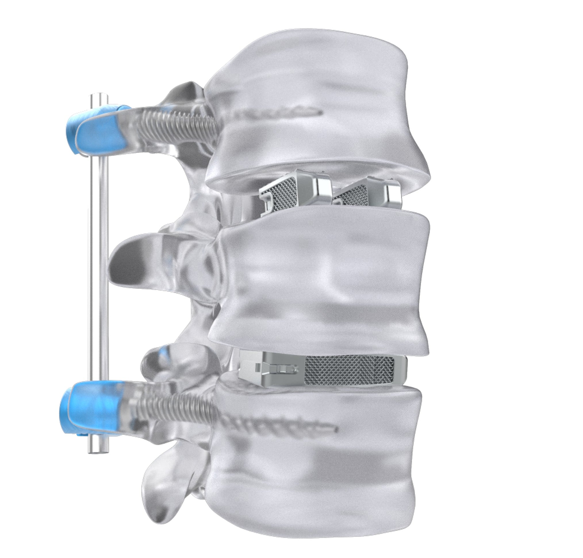 Implants BAAT Medical