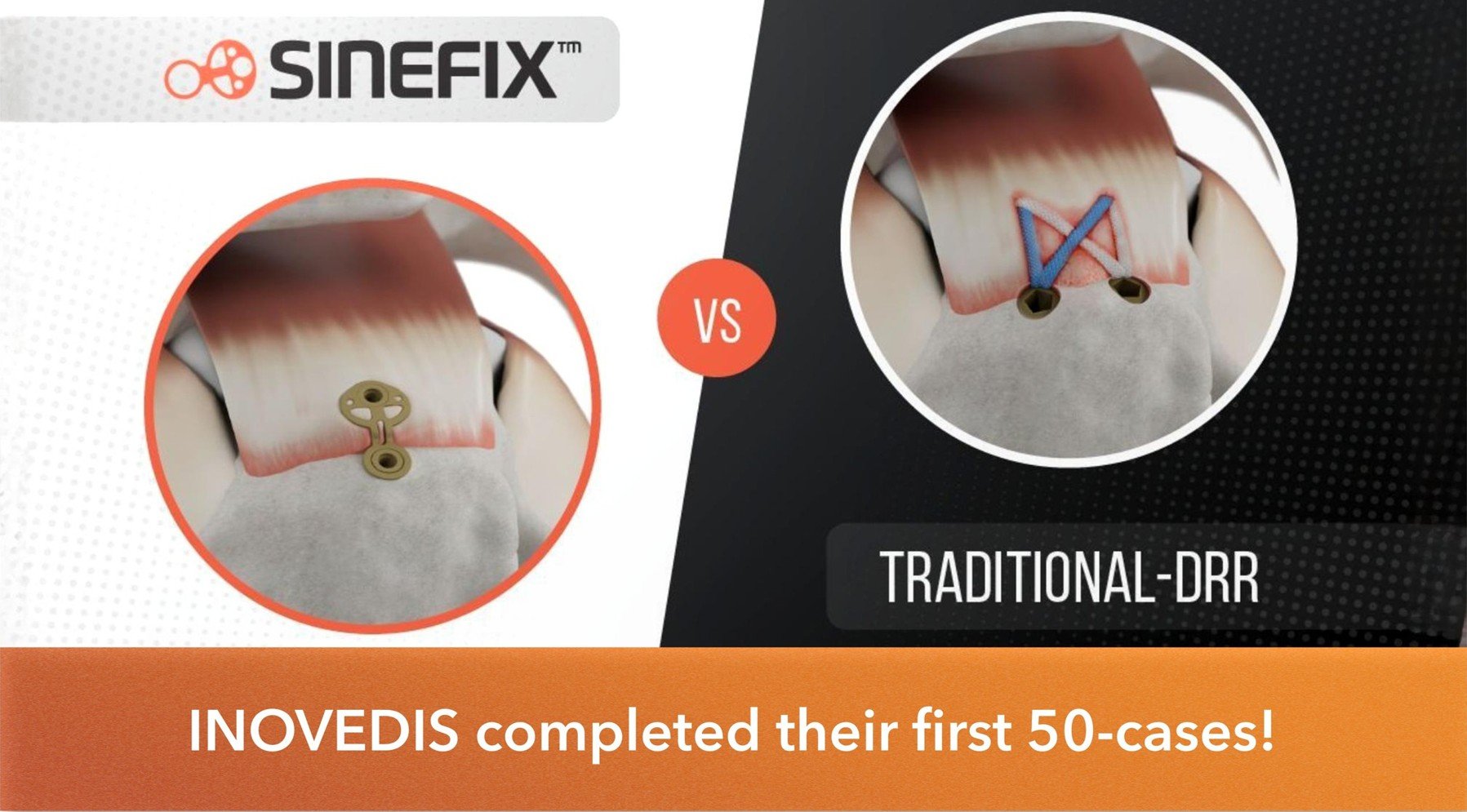 Inovedis milestone with BAAT Medical