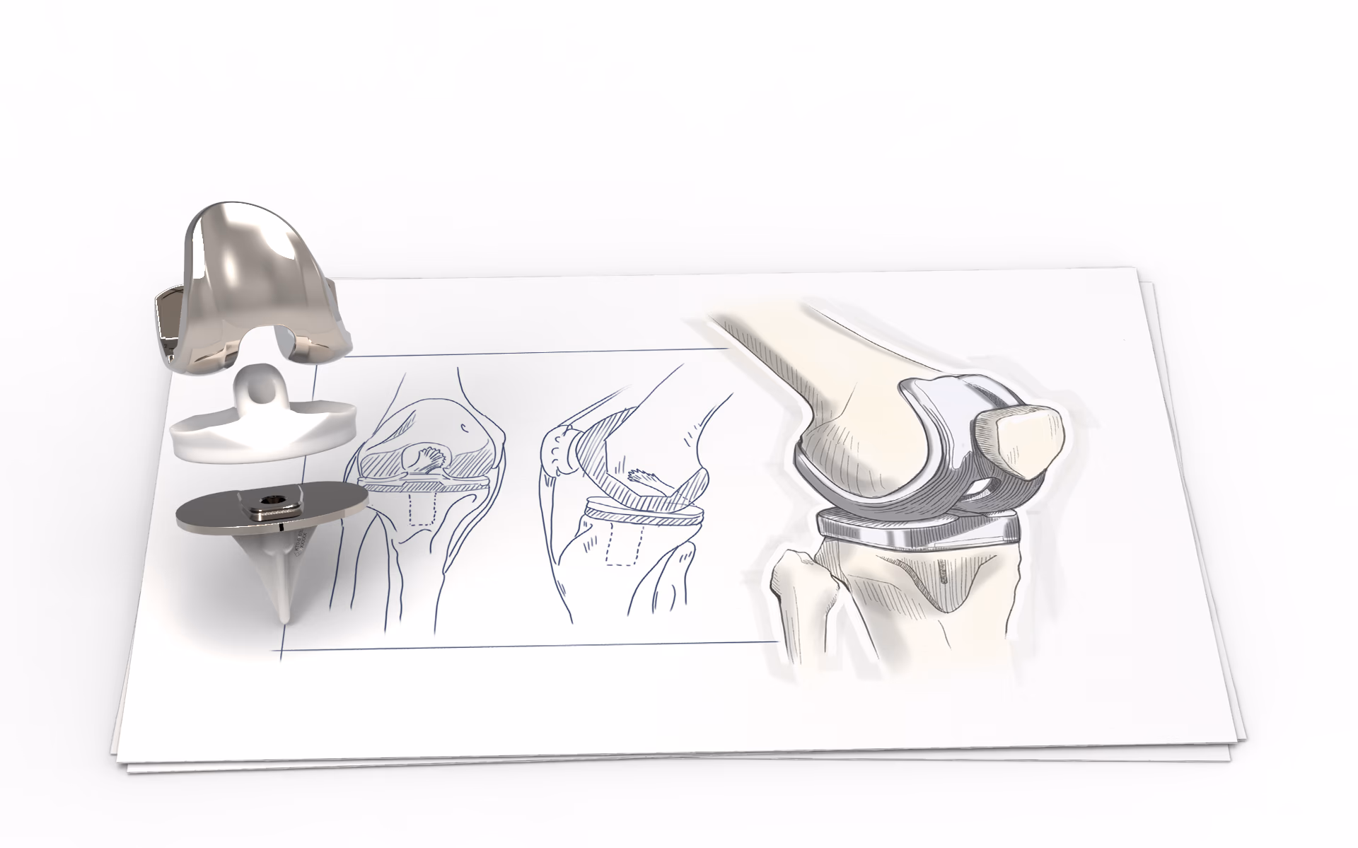 Medical device development from knee implant concept to finished device